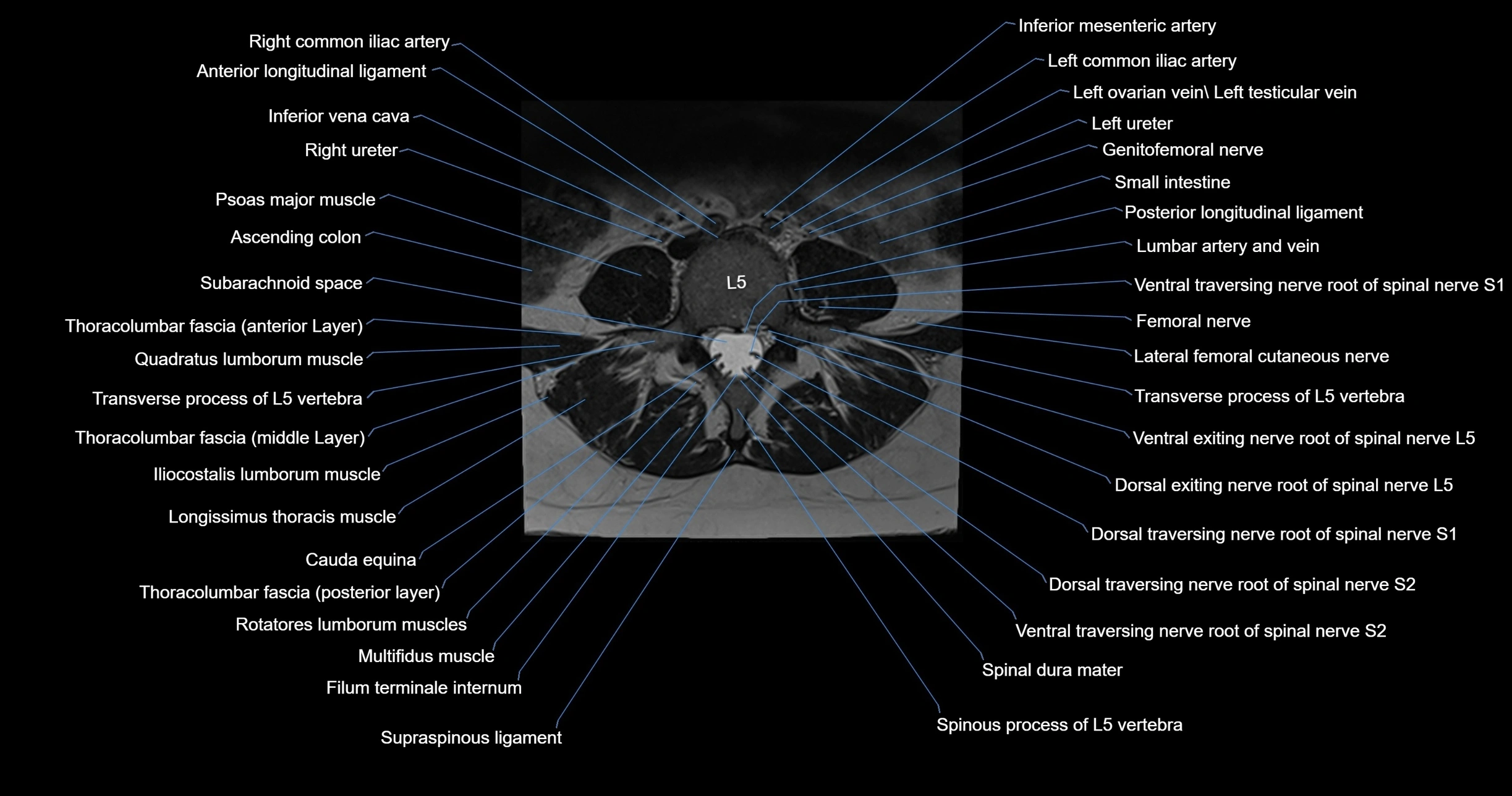 MRI lumbar spine axial cross sectional anatomy 3T radiology  image-img-00001-00037.webp